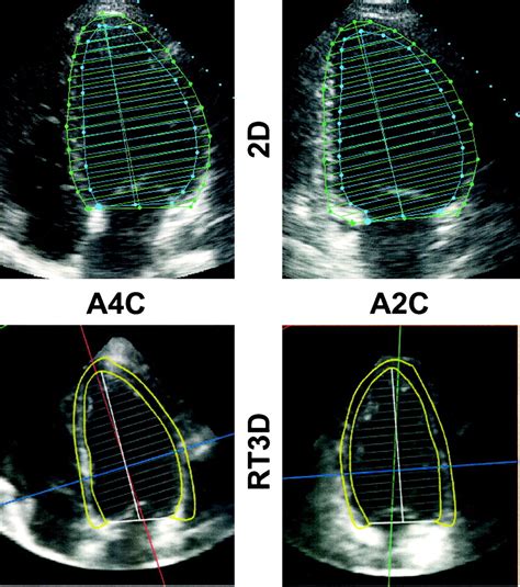 Left Ventricular Mass .